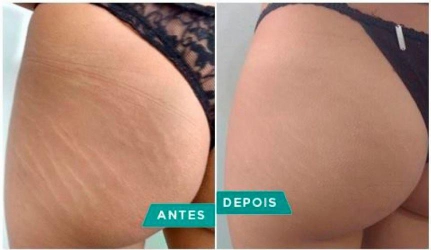 NOVIDADES NO ESTÚDIO DRI TATTO:  CONHEÇA A CAMUFLAGEM DE ESTRIAS